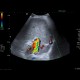 Trombosis of portal vein: US - Ultrasound